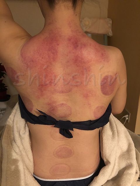 吸玉筋膜スライドカッピング例